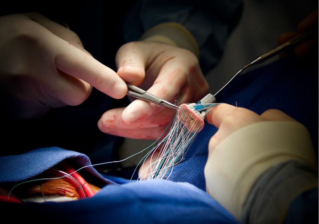 Valve Repair & Valve Replacement in Kanpur | Dr Saeed Akhtar