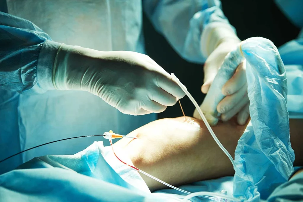 Coronary Artery Bypass Surgery in Kanpur with Dr. Saeed Akhtar.